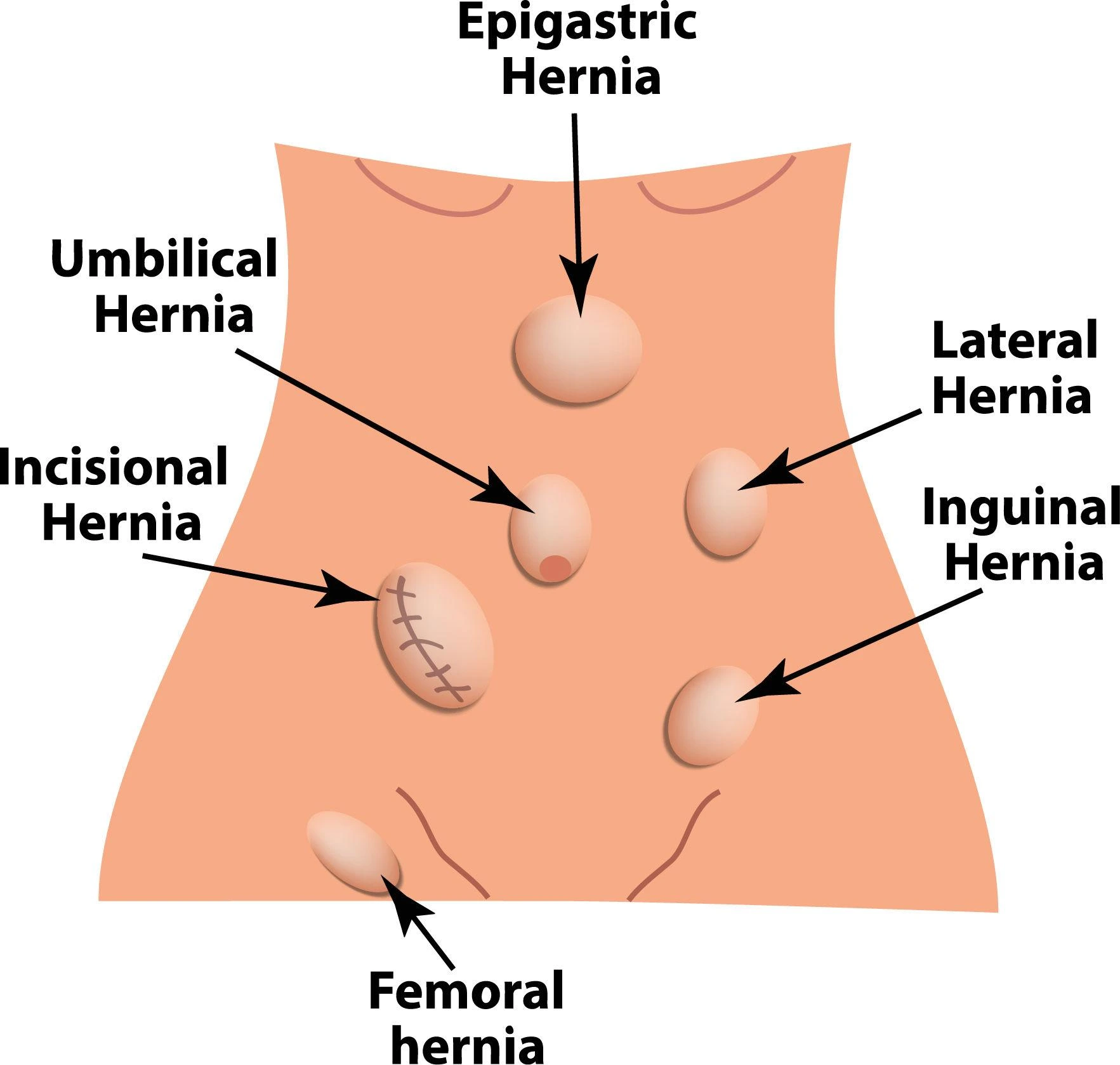 Hernia Surgery Cost in Bangalore: What Affects the Price?